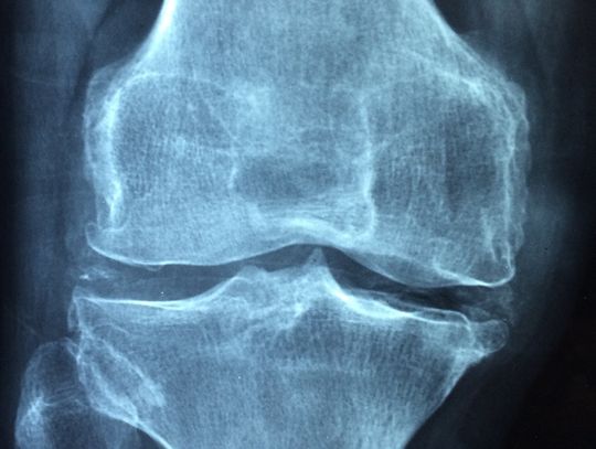 ZDROWIE. Polski wynalazek ma szansę zrewolucjonizować leczenie osteoporozy