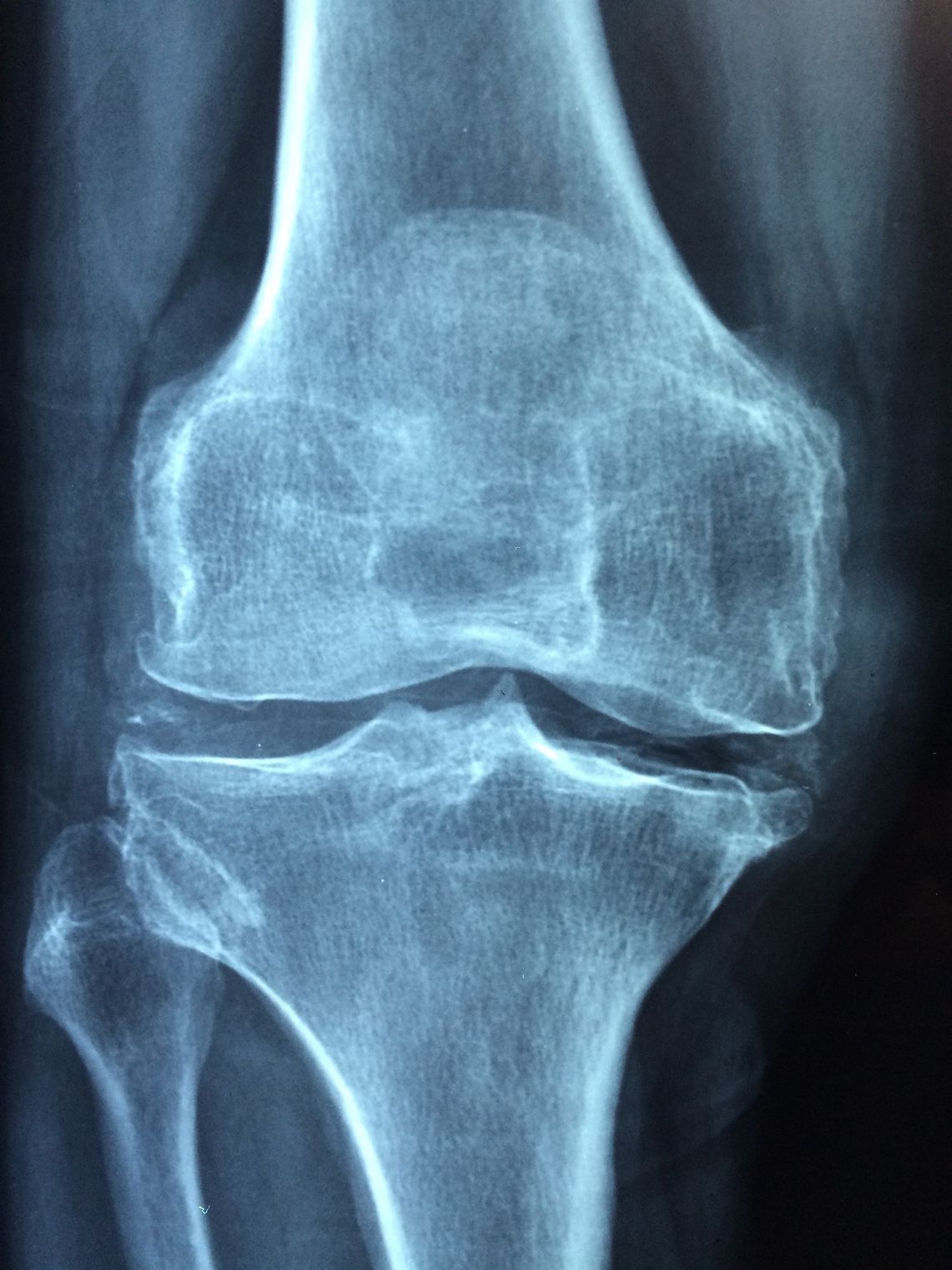 ZDROWIE. Polski wynalazek ma szansę zrewolucjonizować leczenie osteoporozy ZDROWIE. Polski wynalazek ma szansę zrewolucjonizować leczenie osteoporozy
